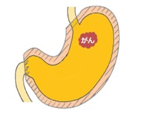 胃全摘術